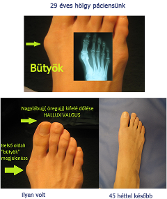 bütyök kezelés, vallux halgus, lábsebészet, belső oldali bütyök